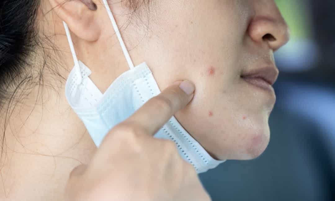 Entenda o aumento do aparecimento de acne pelo uso de máscaras