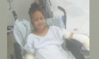 Menina de seis anos cai em fogueira, sofre queimaduras de segundo e terceiro grau e família pede ajuda para tratamento