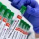 Bahia registra mais três casos de Monkeypox e totaliza 60 infectados