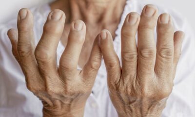 Artrite reumatoide: doença atinge mulheres duas vezes mais do que homens