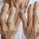 Artrite reumatoide: doença atinge mulheres duas vezes mais do que homens