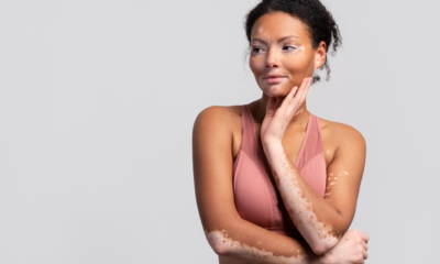 Mês do vitiligo: entenda as causas, sintomas e tratamentos da doença